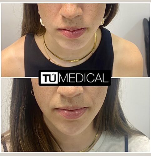 Tratamientos faciales con Ácido Hialurónico en Alcorcón Madrid