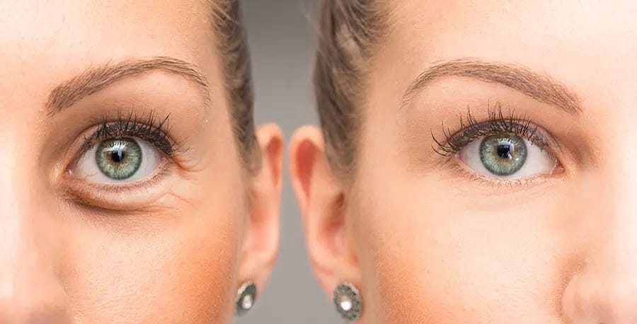 presoterapia ocular en alcorcon