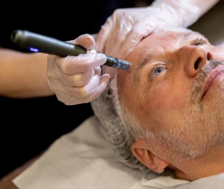 tratamiento dermapen en alcorcon clinica estetica