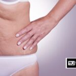 Cómo eliminar la flacidez abdominal