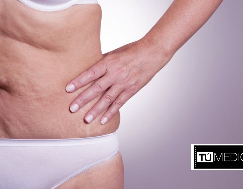 Cómo eliminar la flacidez abdominal