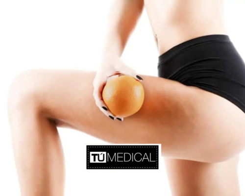 Cómo eliminar la celulitis