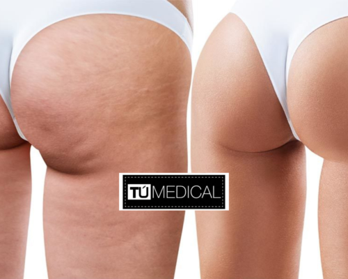 Cómo eliminar la celulitis