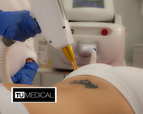 Eliminación de tatuajes