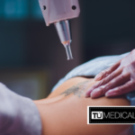 Eliminación de tatuajes