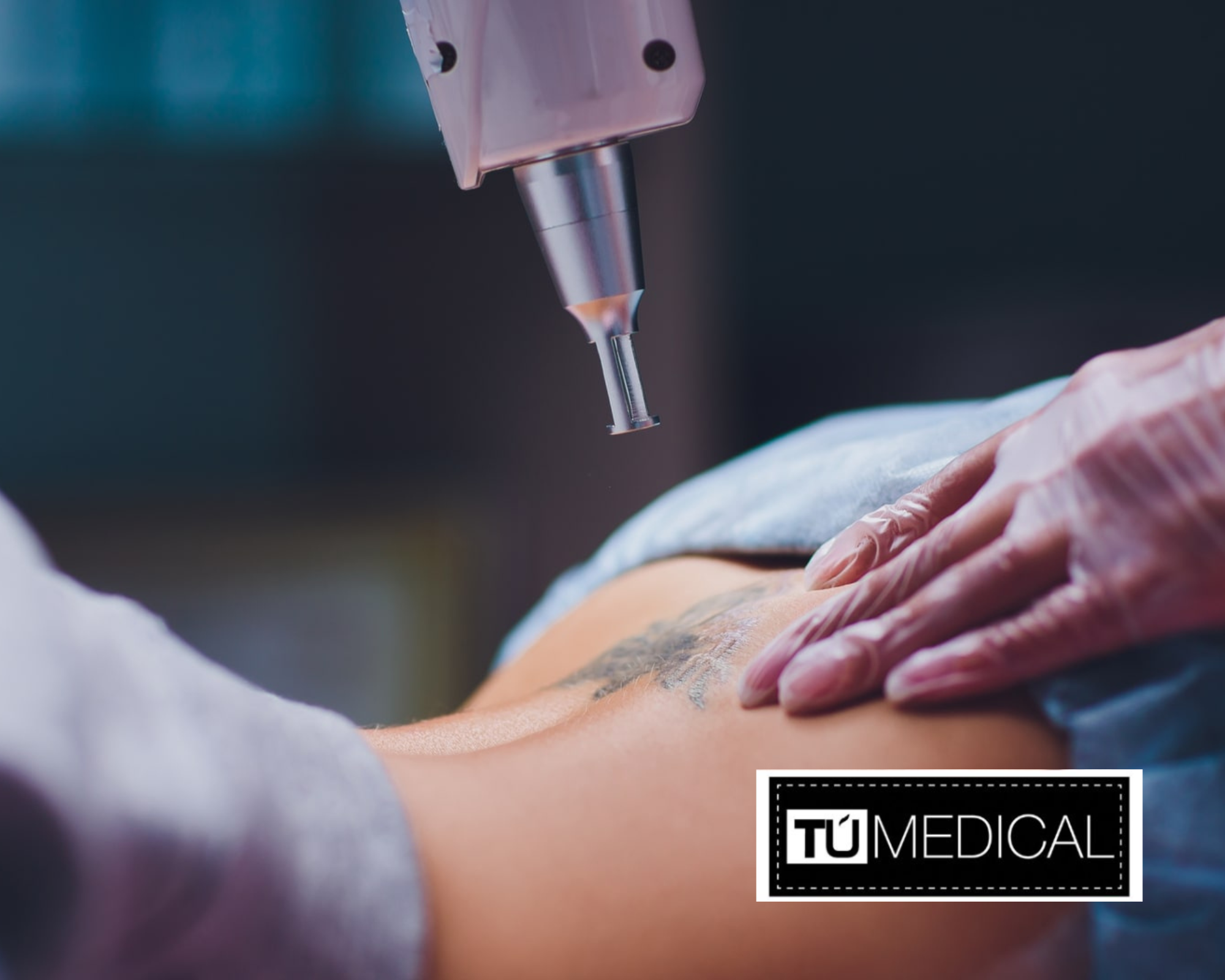 Eliminación de tatuajes