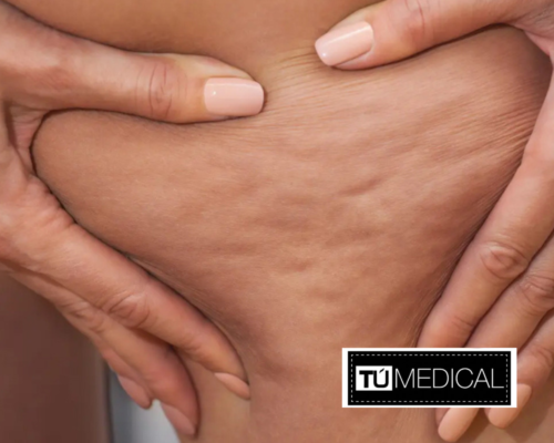 eliminar la celulitis