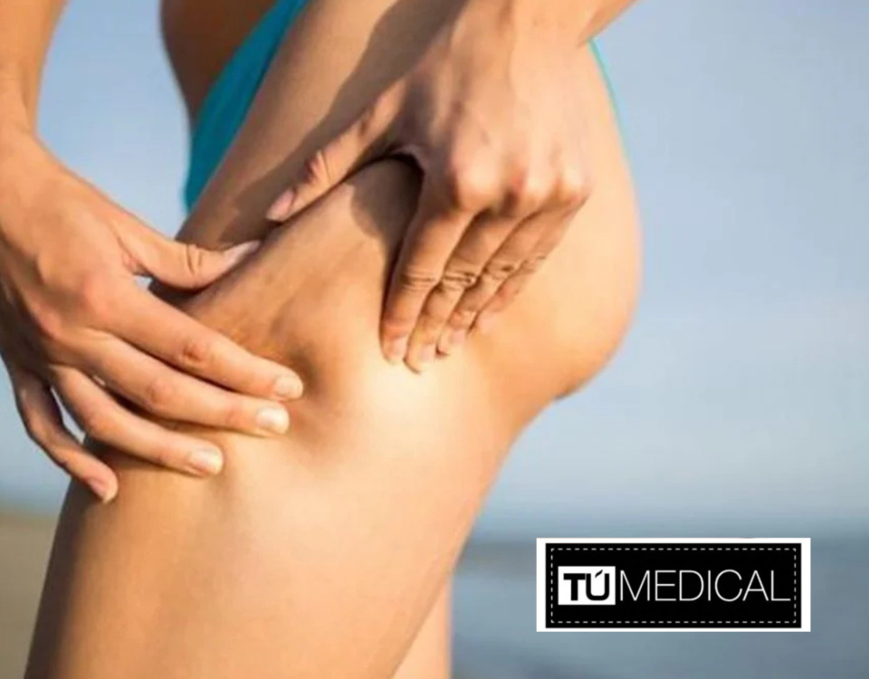 Eliminar la celulitis antes del verano