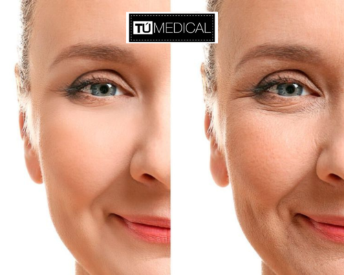 Rejuvenecimiento facial alcorcón