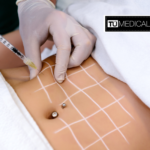 Mesoterapia en Alcorcón