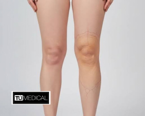 Retención de líquidos en las piernas